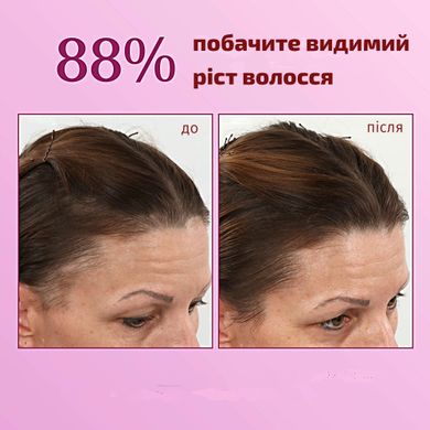 BosleyMD Women's Extra Strength Minoxidil 5% Topical (Foam)